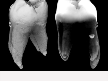 Volume reconstruction of a four rooted maxillary first molar